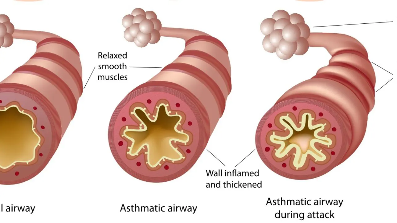 Cannabis and Asthma